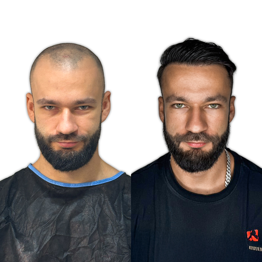 Before and after hair transplant — DHI 3,800 grafts, patient from New York